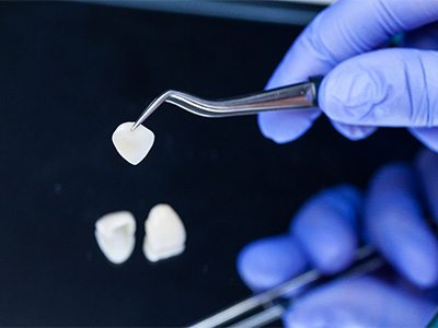 Dentist holding a veneer with tweezers 