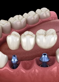 Animated dental bridge being placed over two dental implants