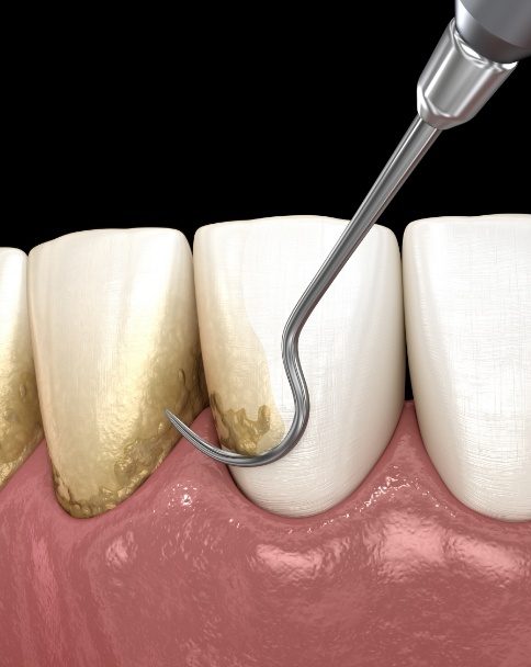 Animated dental instrument removing plaque buildup from teeth