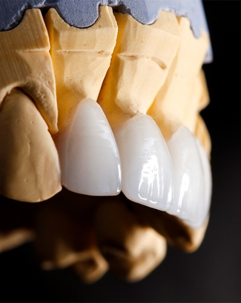 a plaster mold of a mouth with veneers on it