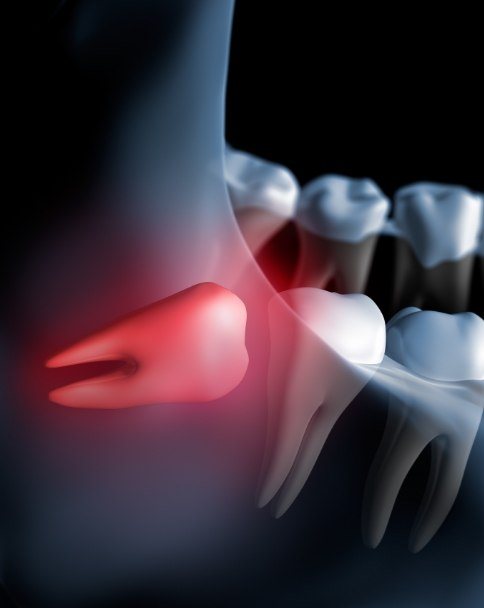 Animated impacted wisdom tooth pushing against back molar